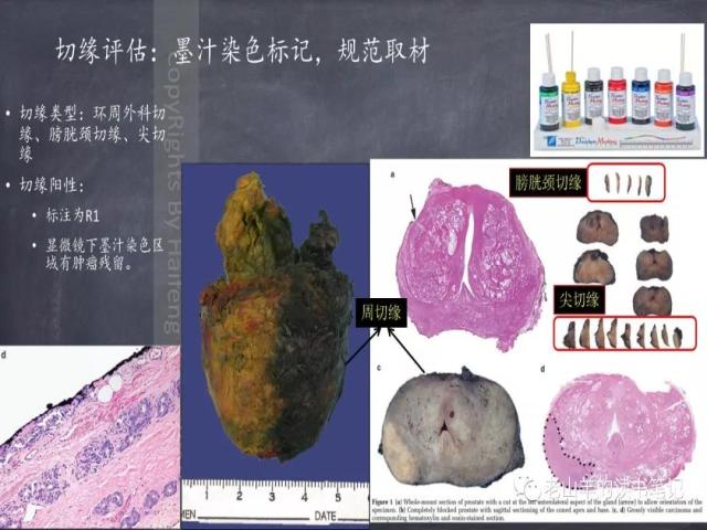 AJCC第8版 前列腺癌分期 之 病理学要点
