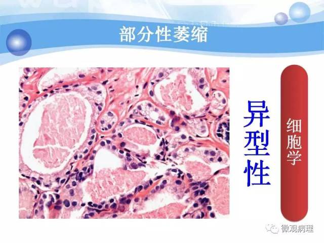 泌尿课程/局灶性前列腺萎缩