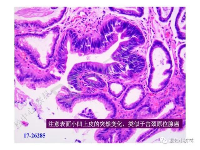 上消化道早癌病理的学习心得体会（附胃牵手癌的病例特点文献学习）