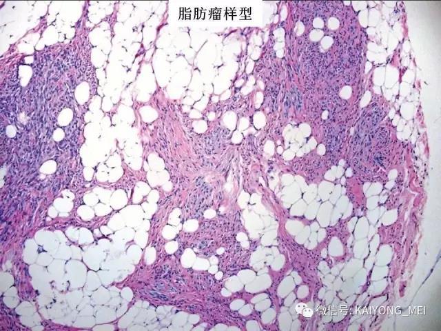 乳腺梭形细胞病变的病理诊断及进展（一）