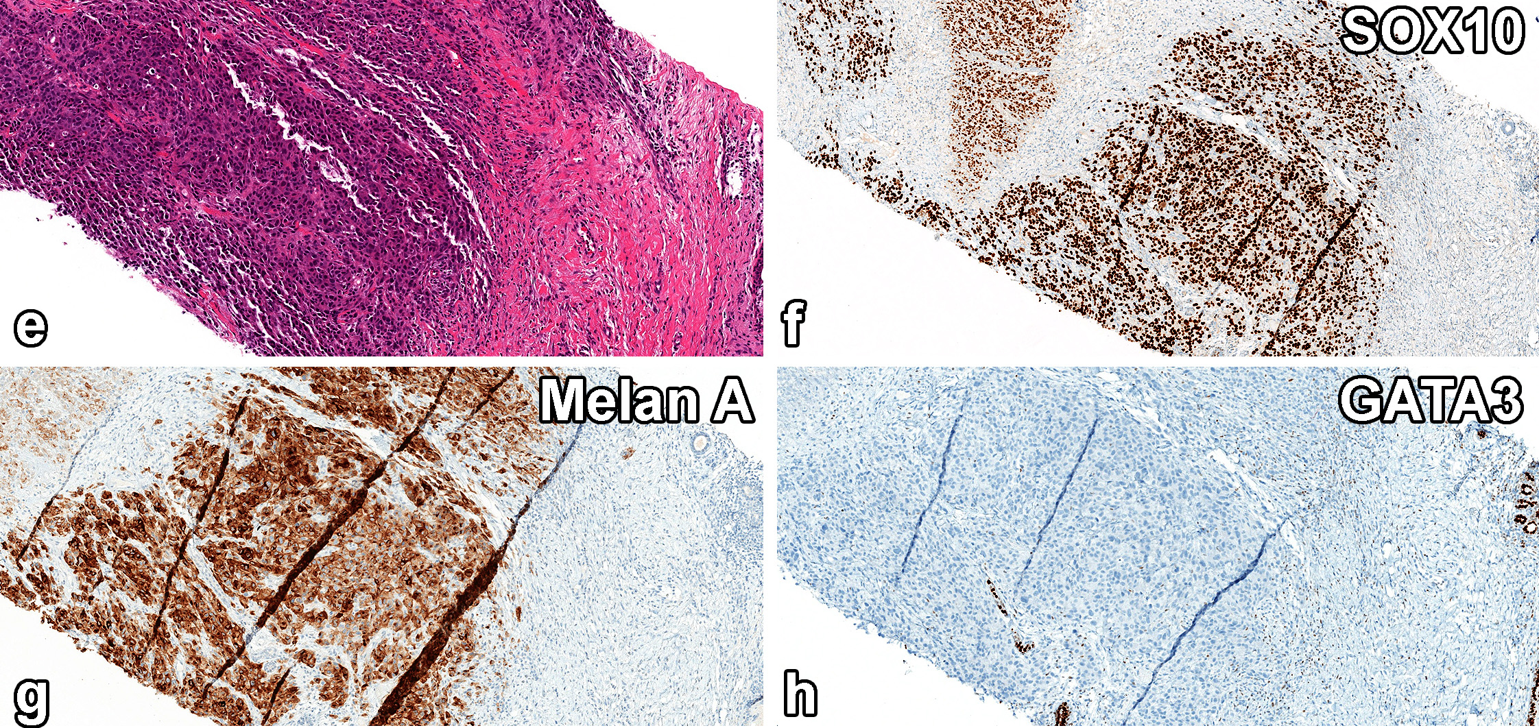 读文献，学病理-乳腺乳头状肿瘤难点总结（一）