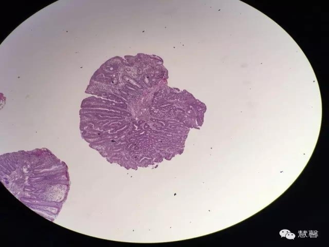 结、直肠管绒毛状腺瘤-高级别病变诊断等相关问题2（悄悄分享、孔祥田(Max)*Roswell*老师讲解）