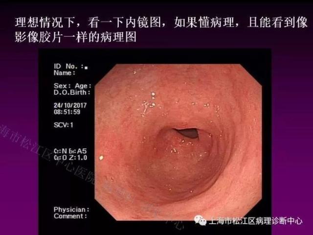 上消化道低级别上皮内瘤变的那些事