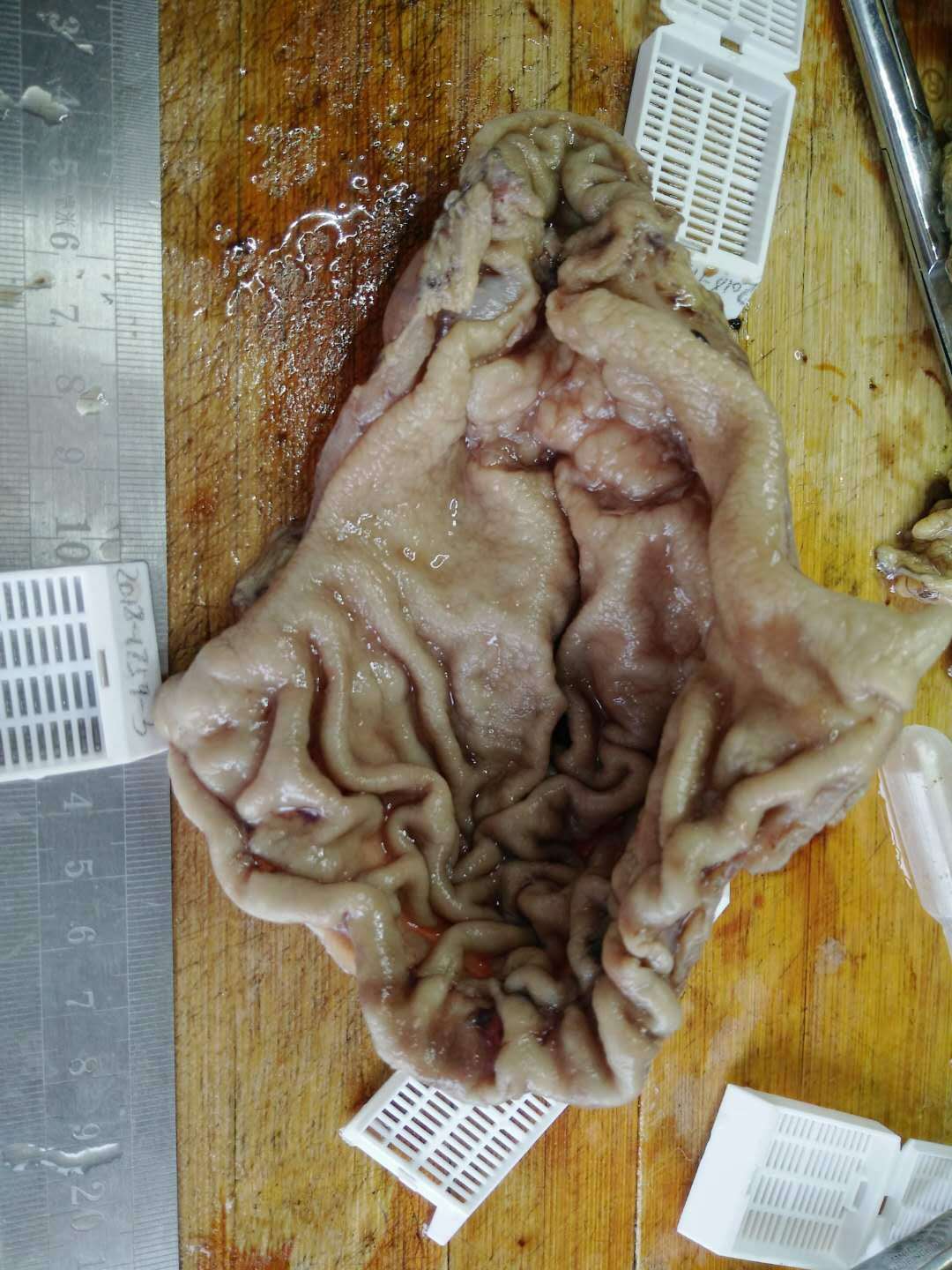 病理科工作札记（二十二）胃印戒细胞癌经典病例