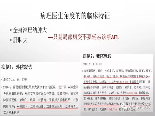 血管免疫母T细胞淋巴瘤的病理诊断
