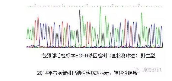 中日韩个体化诊疗案例大赛经典赏析之十——EGFR敏感突变患者，如果TKI原发性耐药，需警惕合并其他驱动基因变异！