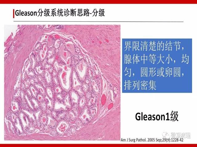 前列腺癌Gleason分级系统的前世今生