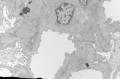 Sixty old man with proteinuria and hematuria图9