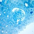 Sixty old man with proteinuria and hematuria图3