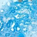 Sixty old man with proteinuria and hematuria图2