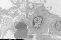 Sixty old man with proteinuria and hematuria图4