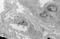 Sixty old man with proteinuria and hematuria图5