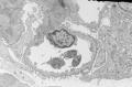 Sixty old man with proteinuria and hematuria图7