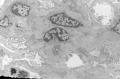 Sixty old man with proteinuria and hematuria图8