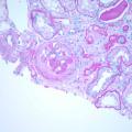 Sixty old man with proteinuria and hematuria图1
